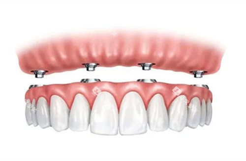 全口种植牙图示