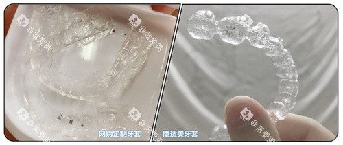 隐形牙套对比照片