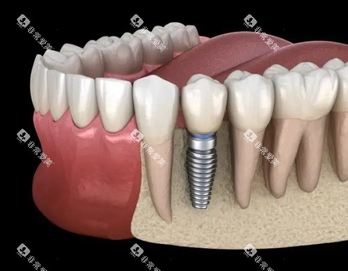 种牙示意图 种牙示意图