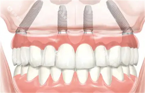 种植牙透视图 种植牙透视图