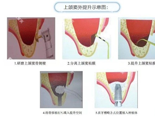 上颌窦提升过程