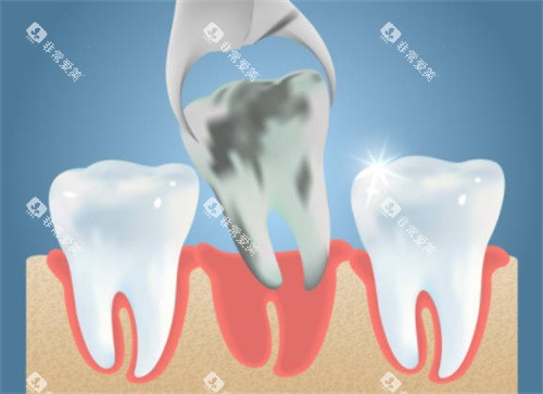 拔掉坏的牙齿 拔掉坏的牙齿