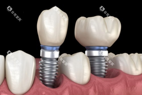 种植牙修复卡通一览 种植牙修复卡通一览