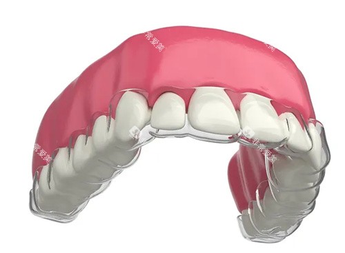 隐形矫正器图示