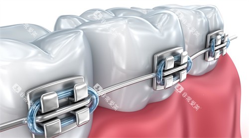 托槽矫正动画图