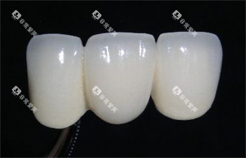 全瓷牙图 全瓷牙图