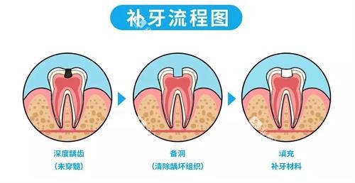补牙的流程