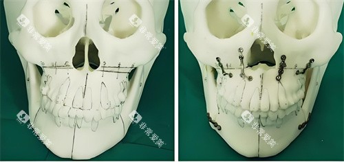 正颌手术手术原理展示图