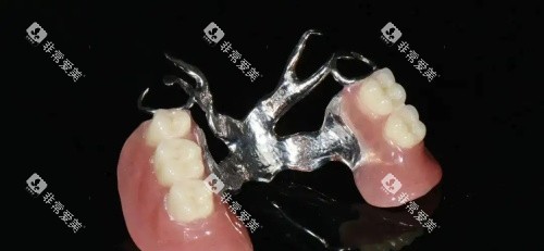 活动义齿维他灵支架示意图