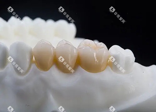 全瓷固定义齿实物示意图