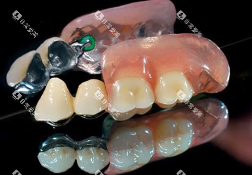 半固定义齿照片
