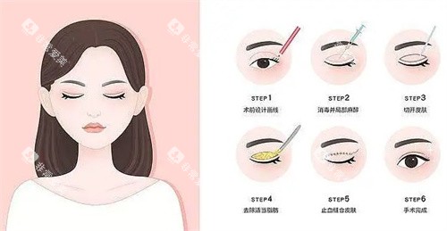 全切双眼皮过程卡通图