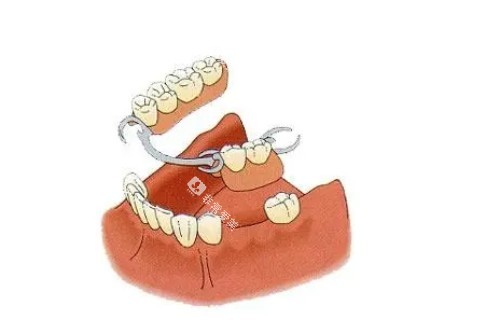 7活动假牙佩戴模型图