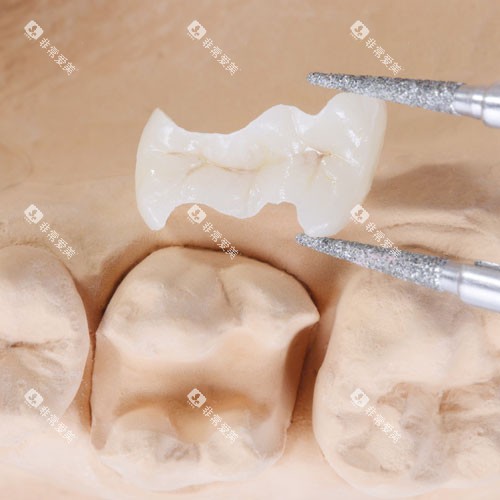 补牙嵌体展示