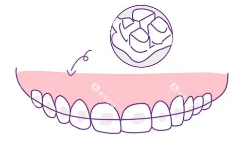 陶瓷托槽 陶瓷托槽