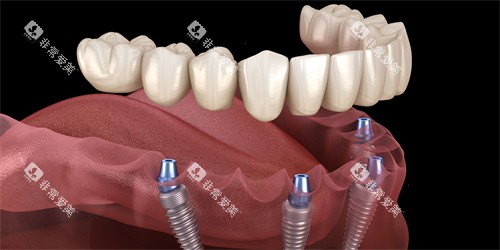 半口种植牙图示