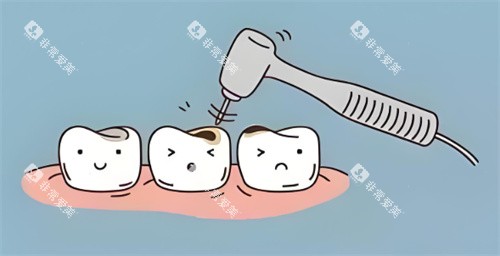 龋齿治疗动画展示图