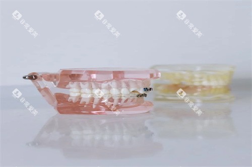 正畸模型图片 正畸模型图片