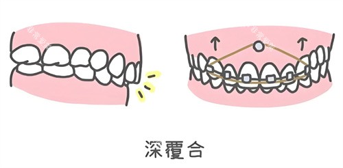 深覆合矫正 深覆合矫正