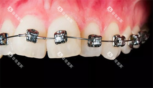 自锁正畸托槽 自锁正畸托槽
