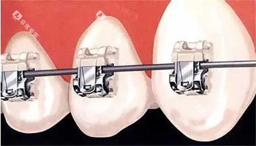 金属自锁托槽细节正展示图 金属自锁托槽细节正展示图