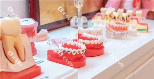 牙套牙模展示 牙套牙模展示