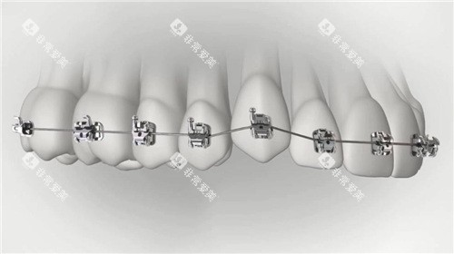 金属托槽矫正图示 金属托槽矫正图示