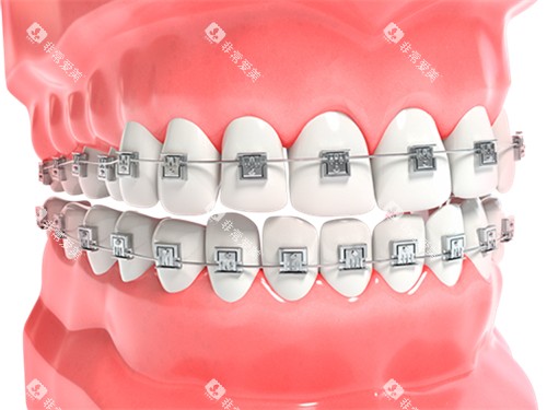牙齿矫正金属牙套漫画图 牙齿矫正金属牙套漫画图