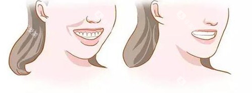 牙齿矫正脸型变化对比漫画图 牙齿矫正脸型变化对比漫画图