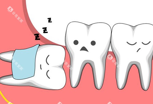 阻生智齿示意图 阻生智齿示意图