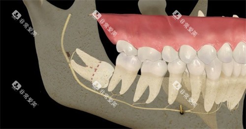 埋伏牙阻生牙示意图 埋伏牙阻生牙示意图