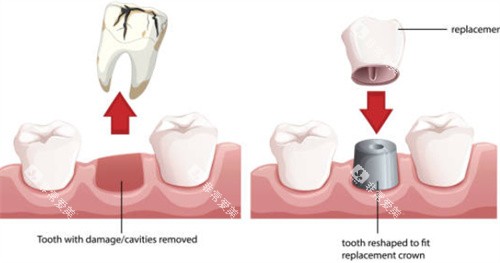 种植牙拔牙和戴冠图 种植牙拔牙和戴冠图