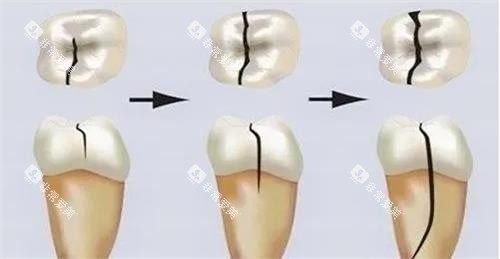 牙齿裂纹的发展过程