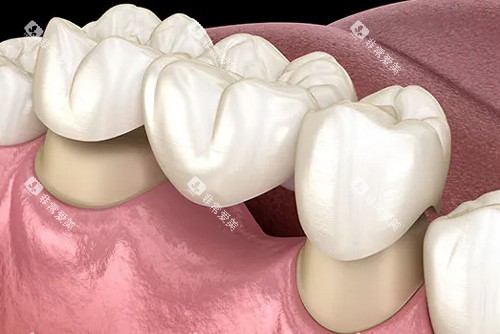 牙冠镶牙示意图