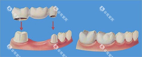 假牙牙冠示意图