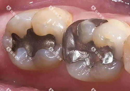 金属材料补牙细节图 金属材料补牙细节图