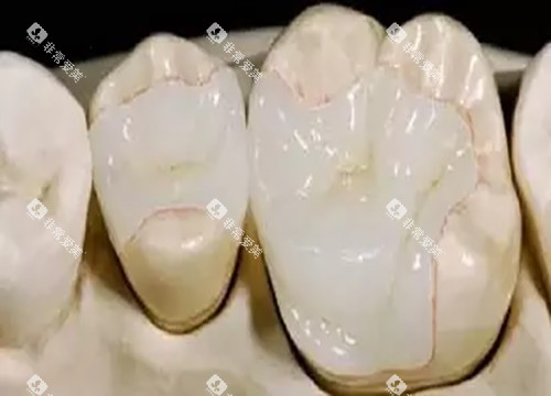 嵌体补牙 嵌体补牙