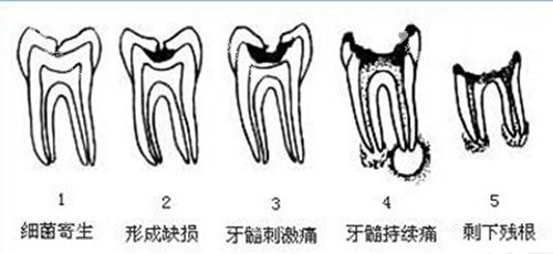 龋齿一度到五度图片 龋齿一度到五度图片