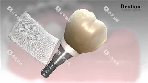 登腾种植牙和骨膜