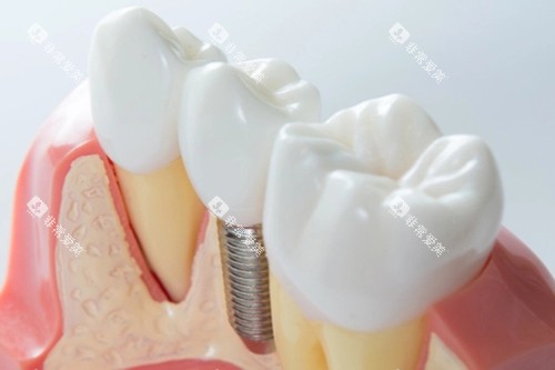 单颗种植牙模型示意图