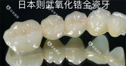 则武氧化锆全瓷牙