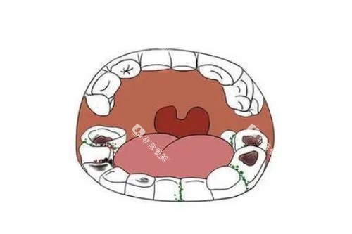 牙齿蛀牙问题卡通图