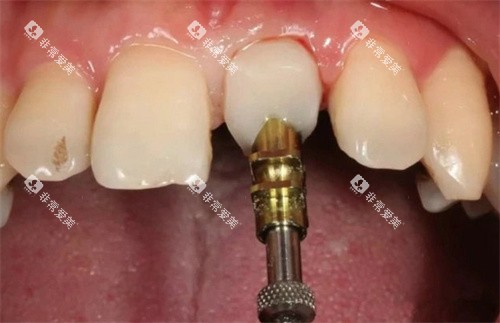 前牙美学修复实拍