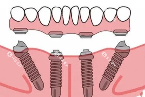 all-on-4种植模型展示图 all-on-4种植模型展示图