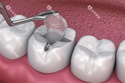 对坏牙进行填补 对坏牙进行填补