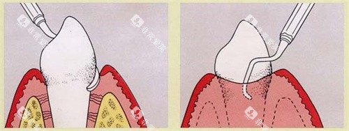 龈下刮治图