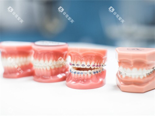 不同的牙齿矫正牙套模型 不同的牙齿矫正牙套模型