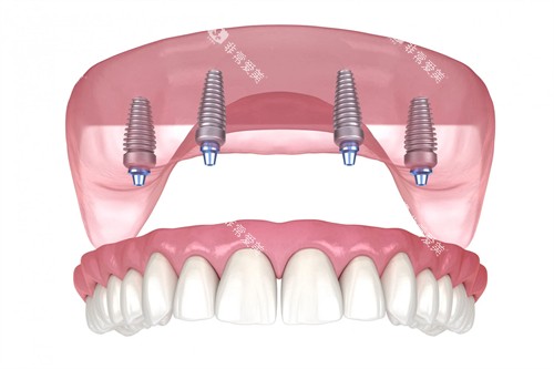 半口种植体展示