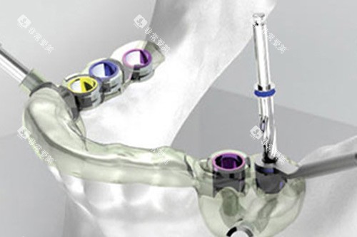 成都新桥口腔疑难种植示意图