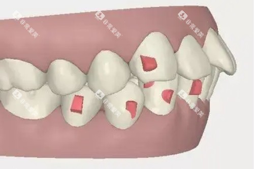牙齿突出卡通图 牙齿突出卡通图